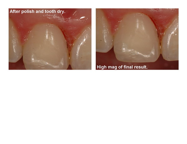 Gingivectomy and restoration Page9_resize.jpg